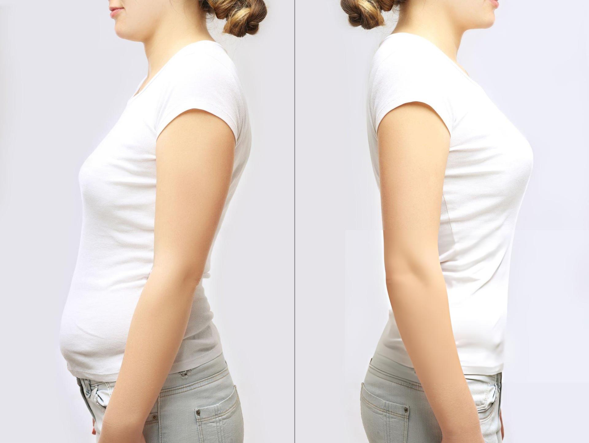 Vaser Liposuction, 2 to 3 Regions